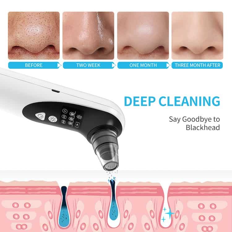 Blackhead Remover