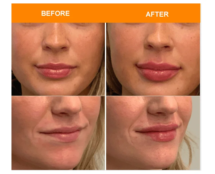 Emerry Hyaluronic Acid Fillers 20ml Derm Plus - Image 4