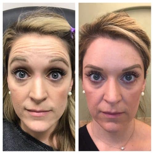 LiftTox 100 Units photo review