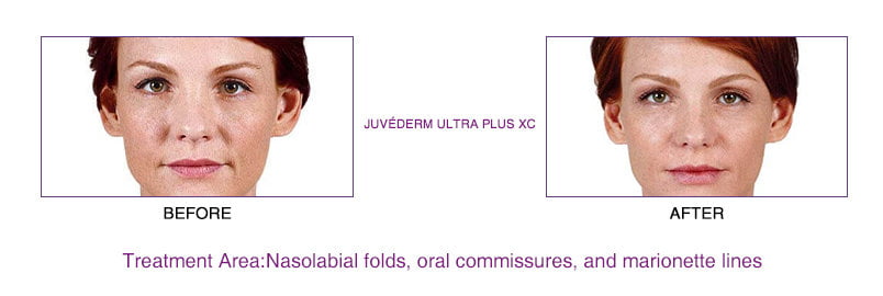 Juvederm Ultra Plus XC before and after