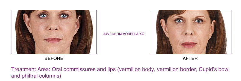 juvederm vobella xc before and after