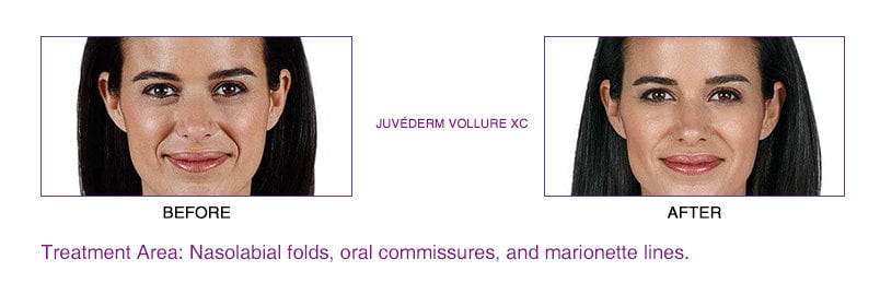 Juvederm Vollure XC before and after
