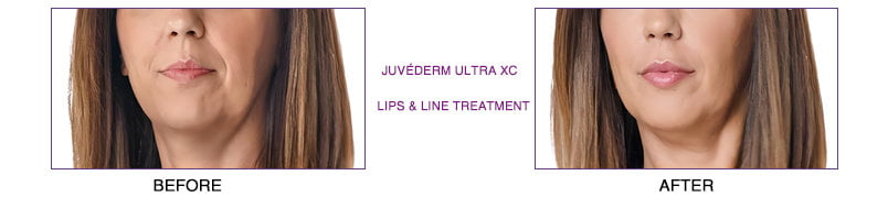 Juvederm ultra xc before and after