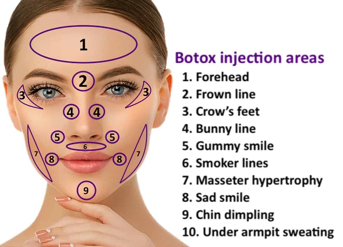 where botox can be injected