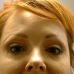 metox after
